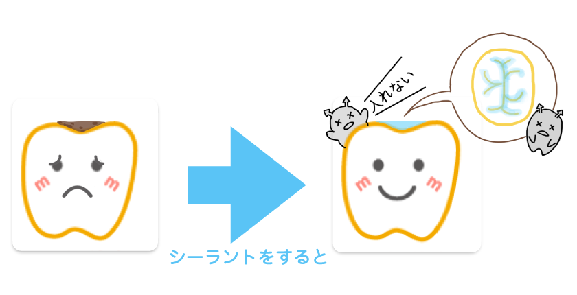 シーラント