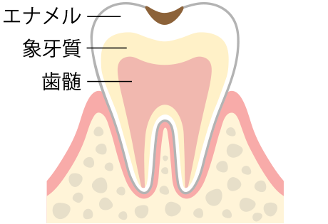 C1（エナメル質の虫歯）