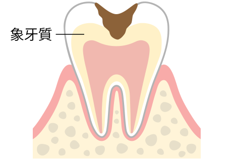 C2（象牙質の虫歯）
