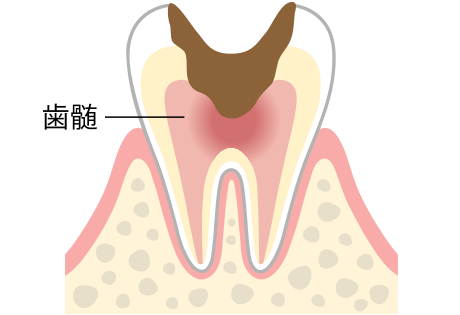 C3（神経・歯髄の虫歯）