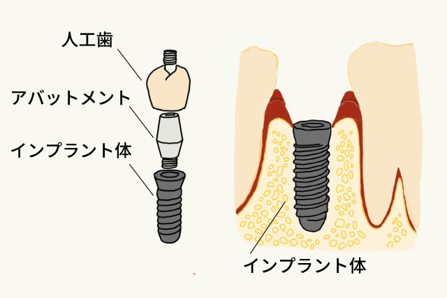 インプラント手術 
