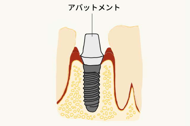 2次手術