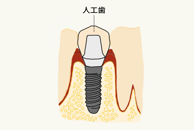 人工歯（上部構造）