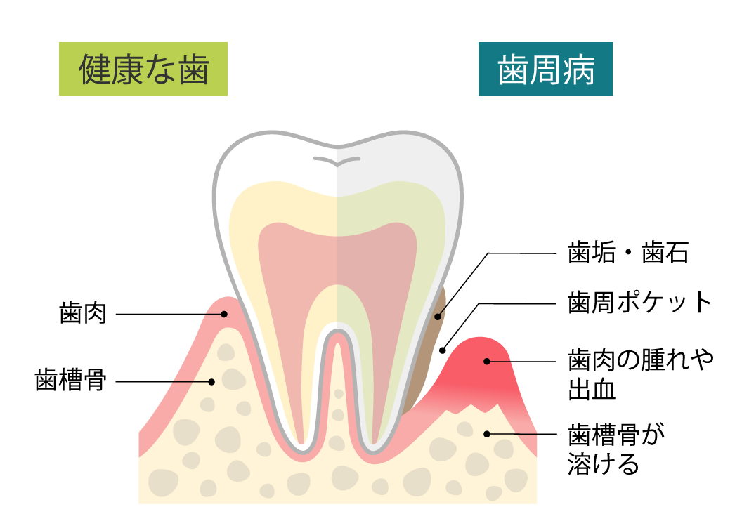 健康な歯　歯周病